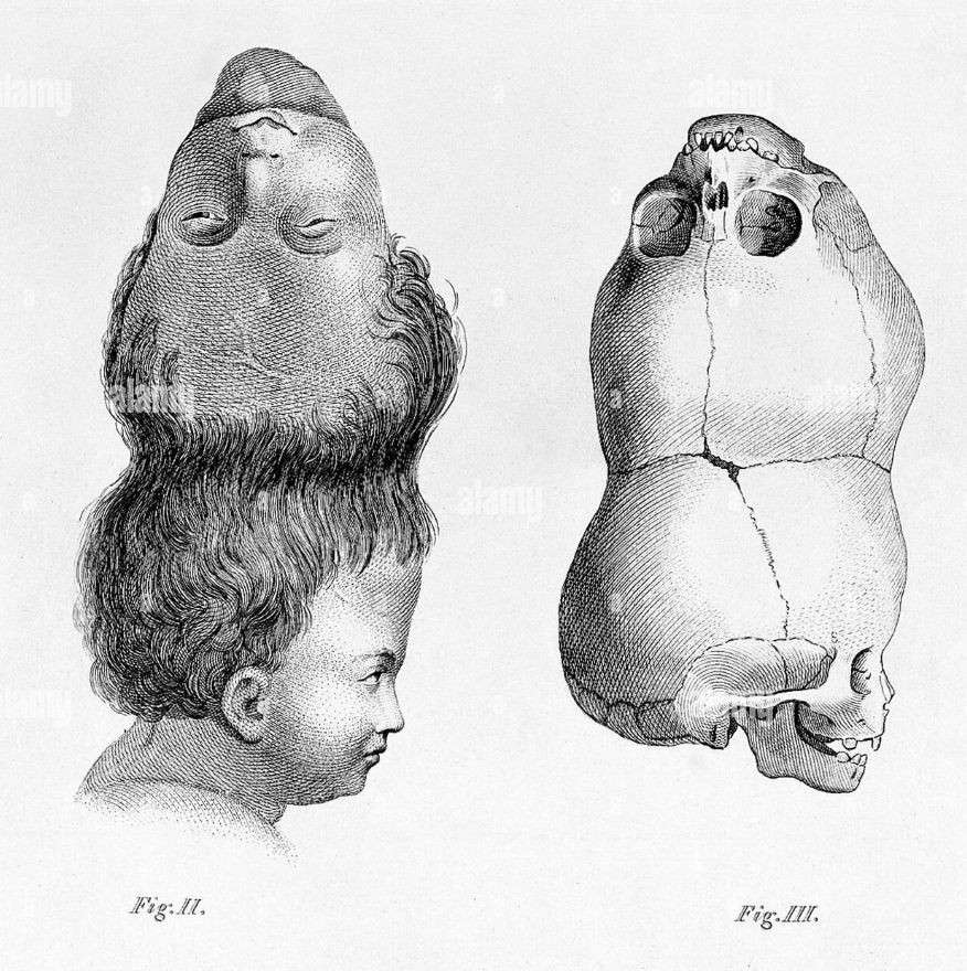 Storia dell'unico bambino a due teste sopravvissuto dopo la nascita: il bambino del Bengala